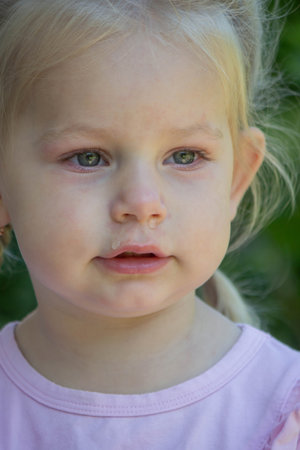 Sad little girl with allergy symptoms outdoors.の写真素材