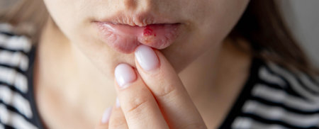 Woman examining a painful herpes sore on her lower lip - viral infection symptomsの写真素材