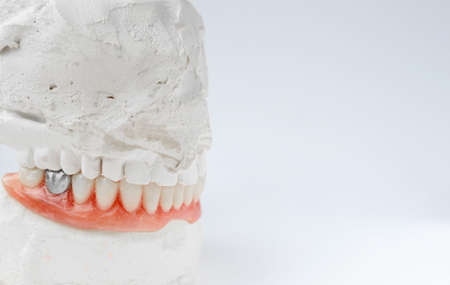 Artificial tooth, dental prosthesis with false silver tooth, metalic crown on tooth. Dentureの写真素材