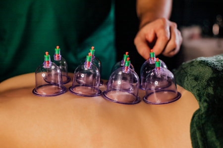 Cupping therapy on back for relaxation and pain relief.の写真素材