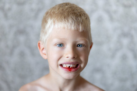 a 6-year-old blond boy with a broken tooth and blood, loss of teeth in children.