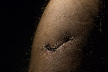 Detail of a healing wound and torn muscle on a leg. Visible scar, dried skin, stitch marks and shaven hair. Dramatical lighting from the left side.の写真素材
