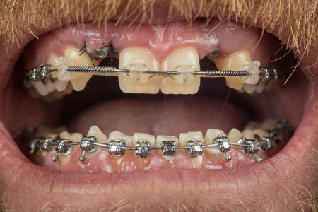Two dental implants on upper jaw and metal braces on both rows of teeth. Lower braces seen with dented wire to align lower row of teeth, tooth number 3 and 4. Ortodontic accesories in mouthの写真素材