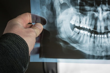 Hand is visible holding an x-ray dental scan of a person with braces on teeth, with visible traces of moving teeth, like bent roots. Two upper teeth are missing.の写真素材