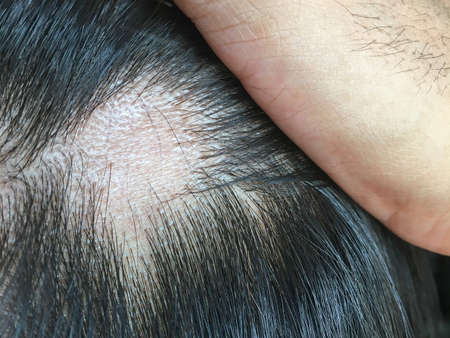 Close up of Symptoms of hair loss from stress on the scalpの写真素材
