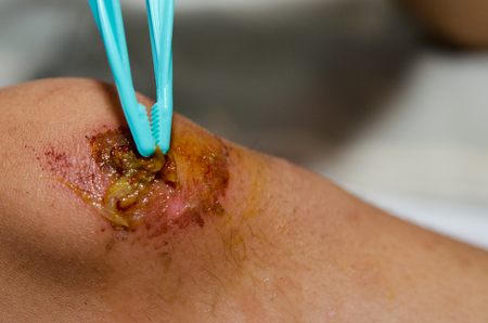 Use clamp cotton cleaning knee injury.の写真素材