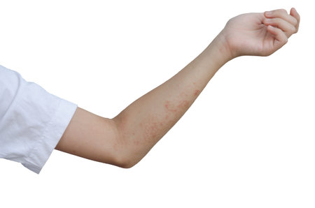 Rash and skin on the arms, isolated on white background.