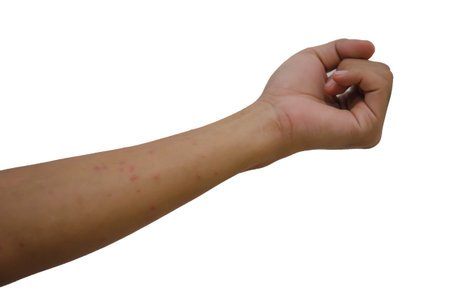 Rash in the arm on the white background.