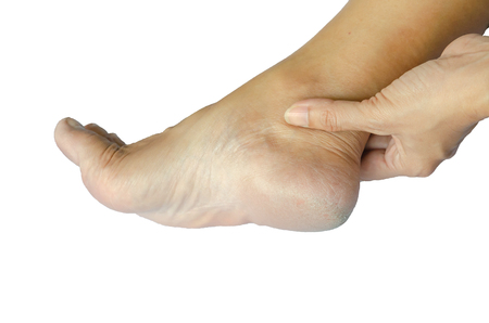 Cracked heels on the white background.の写真素材