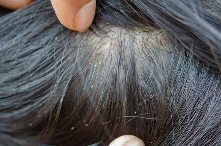 Louse egg on the hair causes itchy head.の写真素材