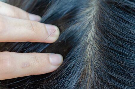 Louse egg on the hair causes itchy head.の写真素材