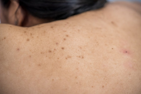 Acne on the back of the skin care woman is caused by bacteria.の写真素材