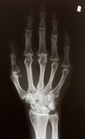 X-ray picture of right handの写真素材