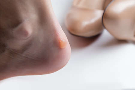 Callus blisters on woman's feet. Uncomfortable shoes problems.の写真素材