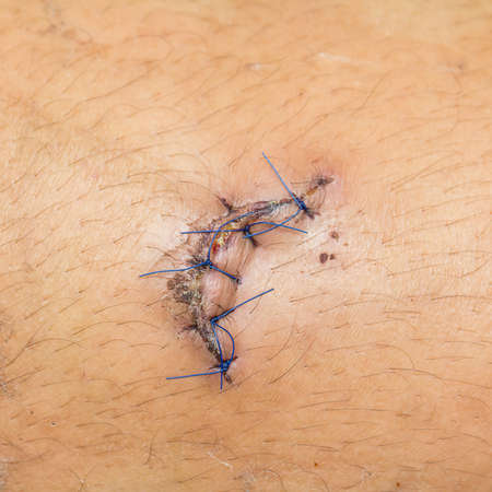 lesionの写真素材