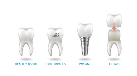 Vector illustration shows healthy tooth braces implant and crown. Detailed dental artwork with realistic tooth models displays various dental procedures and conditions for medical educationのイラスト素材