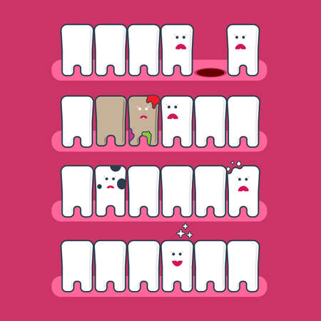 Cute cartoon flat style tooth expression set. Dental problems infographics. Teeth whitening and hygiene.  Treatment of caries, restoration of teethgreat for kids dentist design. Tooth health vectorのイラスト素材
