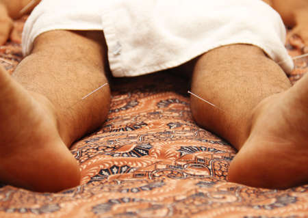 man in an acupuncture therapyの写真素材