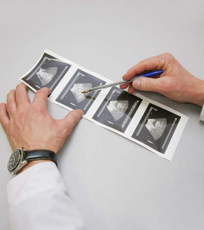 print on paper of inspection of ultrasonography in hands at doctorの写真素材