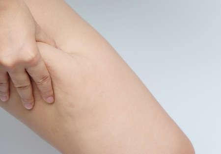 Female legs thighs with cellulite. Skin problem, body care, overweight and dieting concept, diabetic risk factorの写真素材
