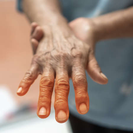 Peripheral Neuropathy pain in elderly ageing patient on hand, palm, fingers, joint and sensory...