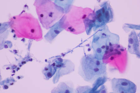 View in microscopic of Candidiasis, fungus infection (Yeast and Pseudohyphae form) in pap smear slide cytology and diagnostic by pathologist.Gynecology report and diagnosis.Medical concept.400Xの写真素材