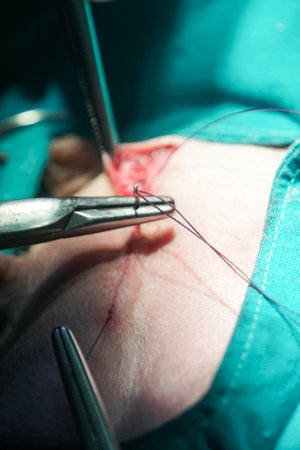 Doctors and nurses tried to use scissors, needles, and threads to close the surgical wound so that...