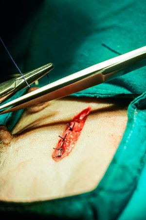 Doctors and nurses tried to use scissors, needles, and threads to close the surgical wound so that the skin was tight. To make the wound after surgery beautifulの写真素材