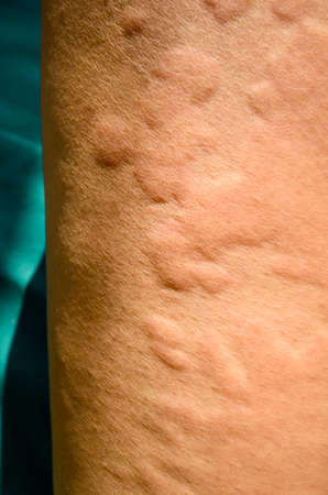 Skin rash, Urticaria, Allergic skin reaction.の写真素材