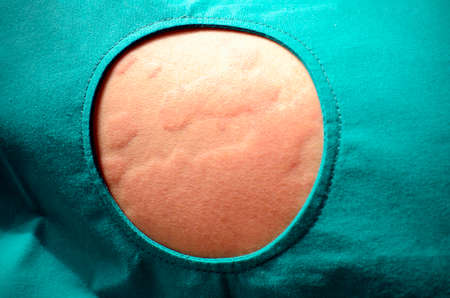 Skin rash, Urticaria, Allergic skin reaction.の写真素材