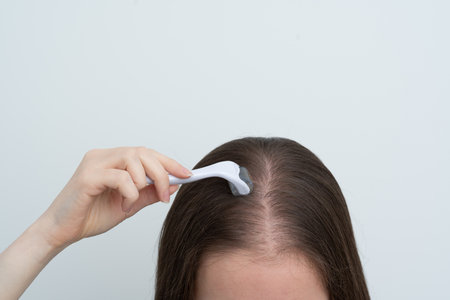 Close up view of young woman using microneedling derma roller on head for stimulating new hair growth, copy space. Alopecia treatment, scalp stimulation, hair loss and baldness targeted therapy.の写真素材