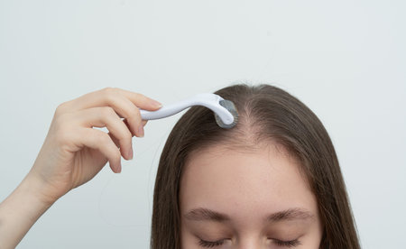 Young brunette woman using microneedling derma roller on scalp stimulating new hair growth with copy...