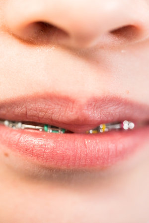 Close-up of the mouth of a girl with rainbow braces.の写真素材