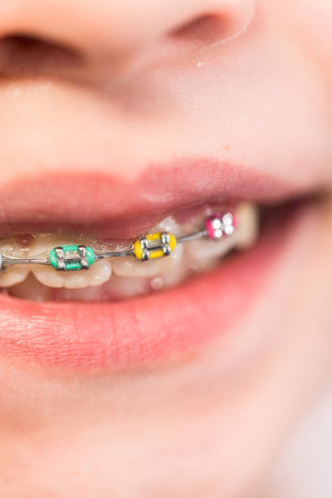 Close-up of the mouth of a girl with rainbow braces.の写真素材