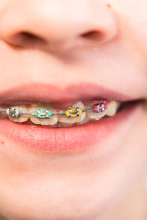 Close-up of the mouth of a girl with rainbow braces.の写真素材
