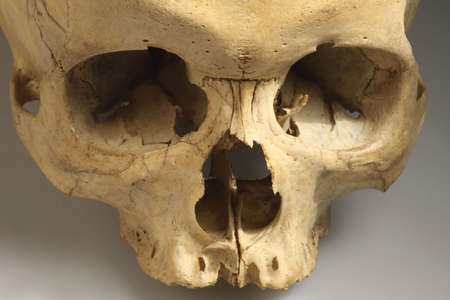 The real skull, this man died on 2008