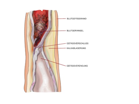 infarction riskの写真素材