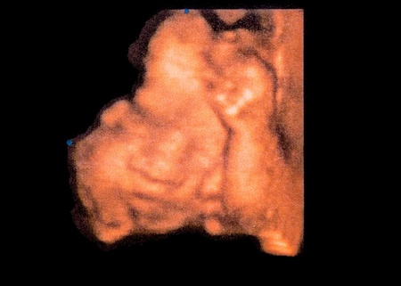 3D sonogram of a 24 week old fetus by ultrasoundの写真素材