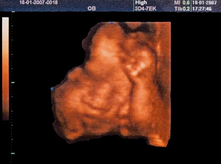 3D sonogram of a 24 week old fetus by ultrasoundの写真素材