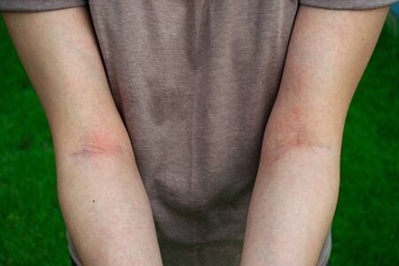 Allergy is a red rash on the body.の写真素材