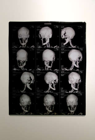 X-rays of the human body where the bones of the legs, arms and close-up of the skull are seen...