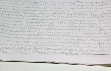 Results of an electroencephalogram after a neurophysiological examination, which is the recording of...