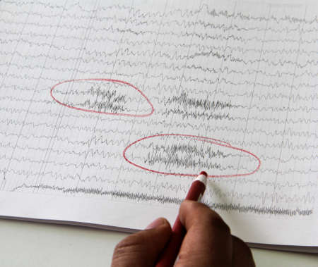 Results of an electroencephalogram after a neurophysiological examination, which is the recording of brain bioelectric activity at rest, wakefulness or sleep, made with electroenceの写真素材