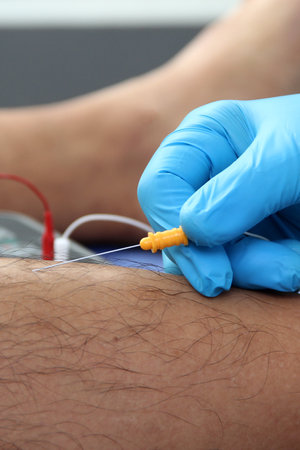 Electromyography in the lower limbs, graphic recording technique of the electrical activity produced by the tibial muscle performed by a specialist neurologistの写真素材