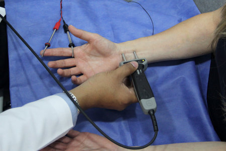 Electromyography EMG and Somatosensory Evoked Potentials PESS on the hand and arm of a female...