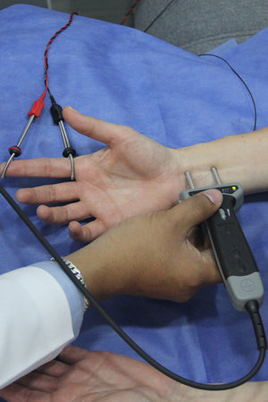 Electromyography EMG and Somatosensory Evoked Potentials PESS on the hand and arm of a patient to...