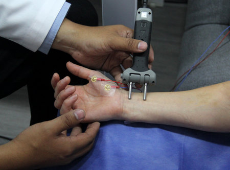 Electromyography EMG and Somatosensory Evoked Potentials PESS on the hand and arm of a female...