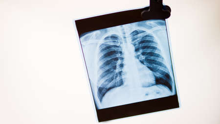 Chest X-rays on negatoscope. Negatoscope isolated on white background.