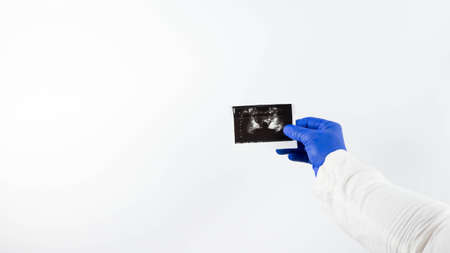 Prostate gland of a man on an x-ray at a doctor in his hand on a white background, a medical worker analyzes a picture of the prostate. On a white background.の写真素材