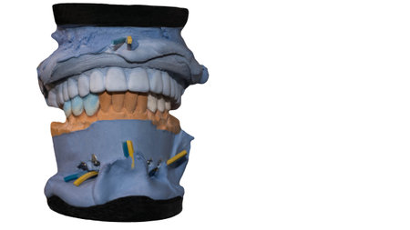Ceramic crown of a tooth on a plaster model of the teeth is isolated on a white background, the work...